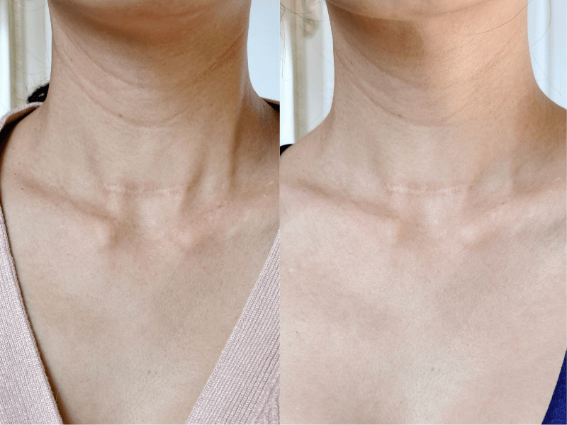 Currentbody series 2 neck mask before and after