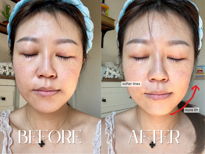 ZIIP Halo immediate before and after