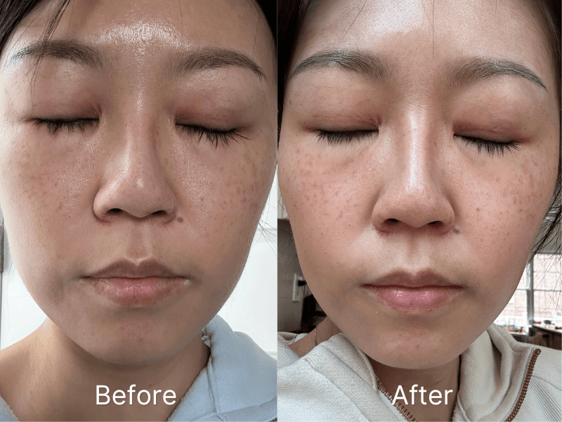 ViQure Lumirea DPL & NIR device before and after