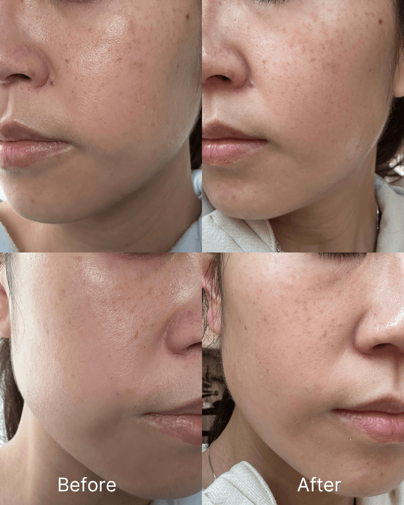 ViQure Lumirea DPL & NIR device before and after