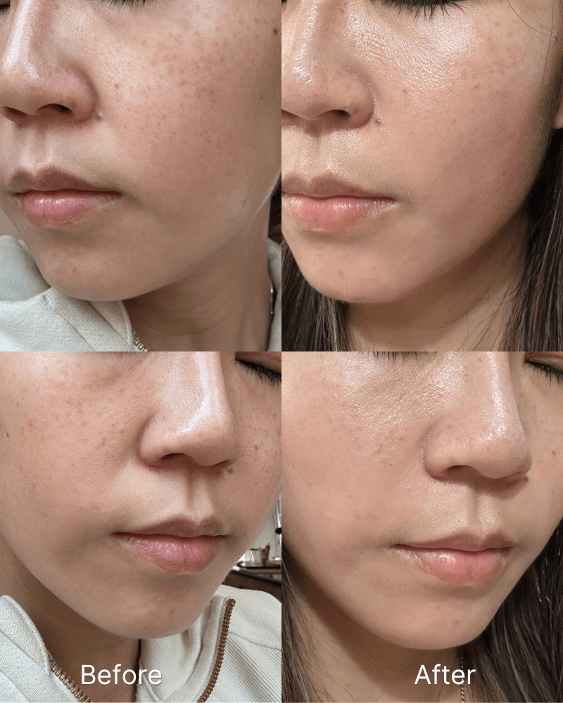 Nuvane SenoP3 before and after