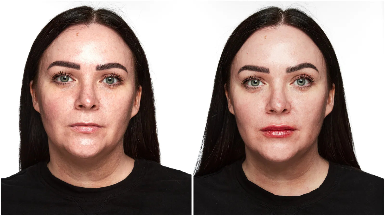 lip filler before and after results