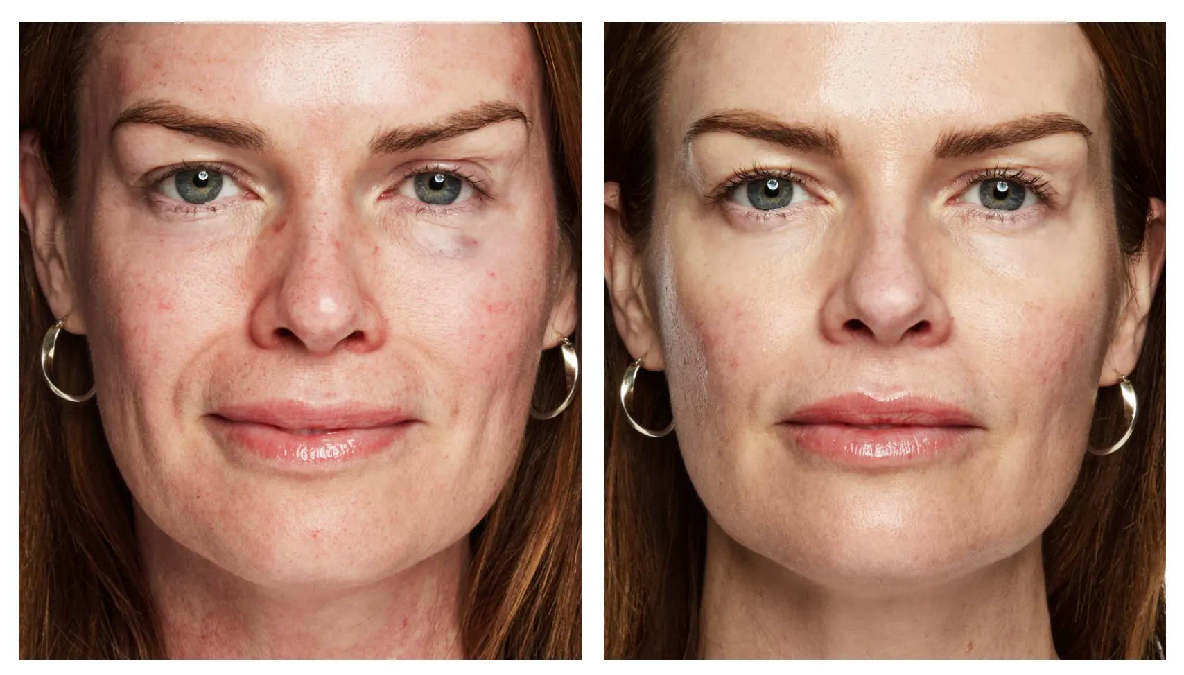 morpheus8 treatment before and after results