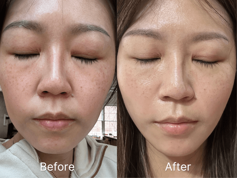 Nuvane SenoP3 before and after