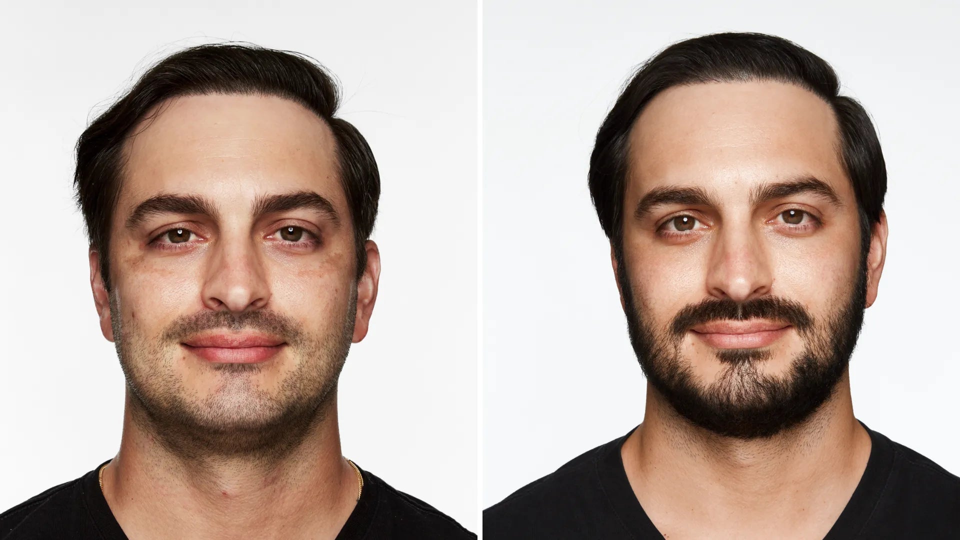 moxi laser results
